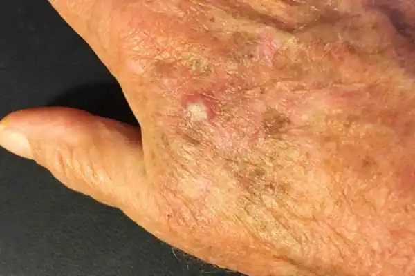 CryoPen for Actinic Keratoses 1 Image of Actinic keratoses High Wycombe on a person hand